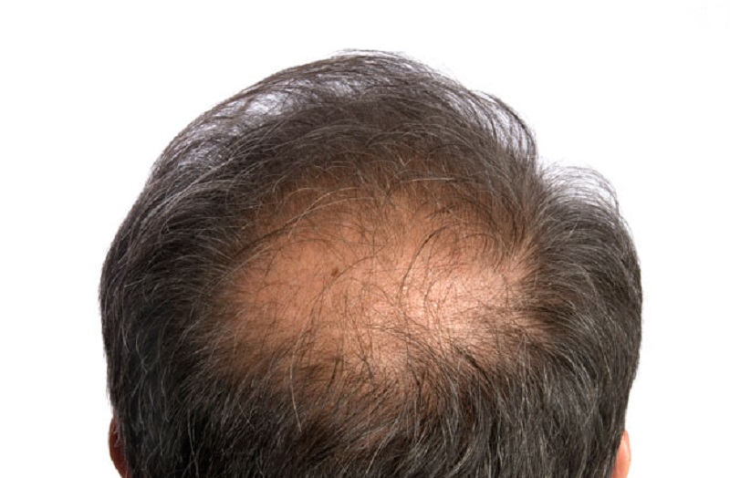 Выпадение волос у мужчин лечение. Залысина на макушке у мужчин.