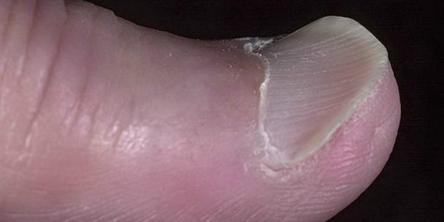 Ложковидные ногти