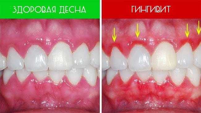 Как выглядит гингивит