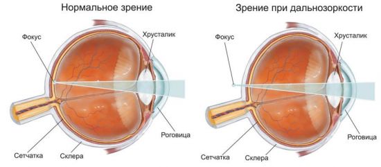 Зрение при дальнозоркости