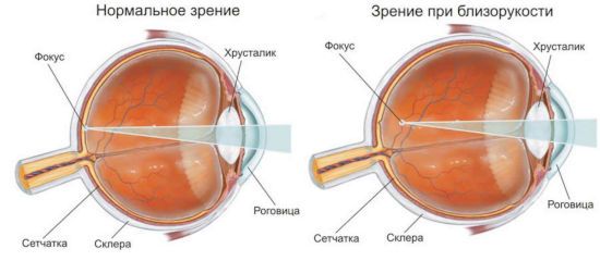 Зрение при близорукости