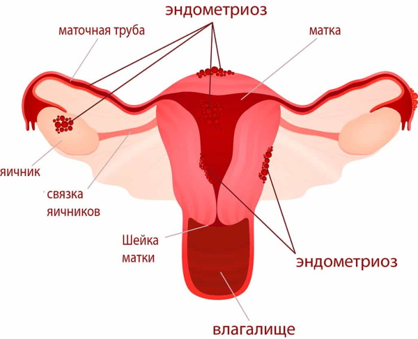 Яичники у женщин. Где находятся, размеры, симптомы воспаления, кисты, опухоли. УЗИ, лечение и последствия удаления