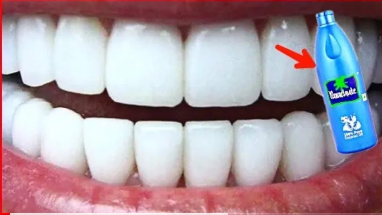 Как можно отбелить зубы в домашних условиях. Отбеливание зубов в домашних условиях. Виниры белизна зубов. Как отбелить зубы в домашних условиях.
