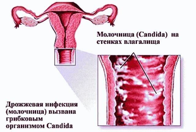 Как вылечить молочницу раз и навсегда?