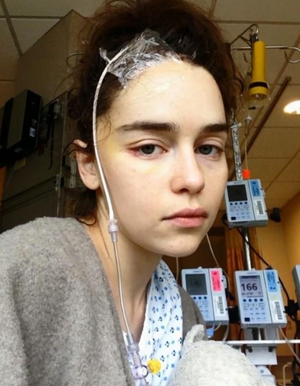 В 2011 году, после съемок в первом сезоне "Игры престолов" актриса перенесла субарахноидальное кровоизлияние и операцию на мозге. Фото: кадр видео. 