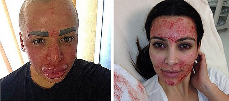 Джордан не только пытается одеваться как Ким, но и следует ее бьюти-режиму, делая те же процедуры, что и она – например, «кровавую» маску для лица или уколы ботокса. Фото: Instagram. 